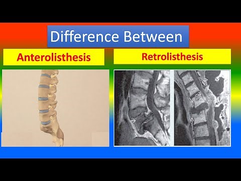 Difference Between Anterolisthesis and Retrolisthesis