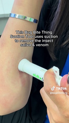 😳🤯 How fast can you get rid of a bug bite? 🦟 With Bug Bite Thing Suction Tool get rid of the discomfort from bug bites and stings in seconds! 🐝 This thing uses ONLY suction to remove the insects saliva or venom from under your skin, so no more itching, stinging, or swelling! 🤩🙌 #BugBiteThing #SuctionTool #InsectBiteRelief #BugBites #MosquitoHack #Hack