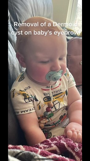 Removal of a dermoid cyst! #dermoidcyst #poorbaby #fyp