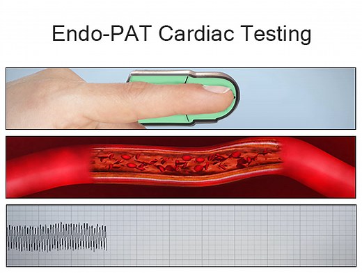 Endo-PAT Cardiac Testing Doctor Manhattan NYC