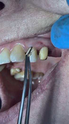 Satisfying Dental ASMR | Retraction Cord Removal