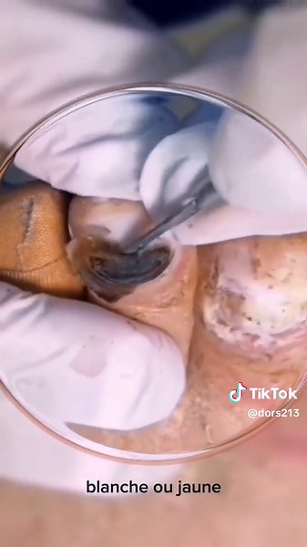 Comprendre les Mycoses des Ongles : Diagnostic et Traitements