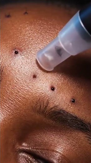 “Oddly Satisfying Blackhead Removal Compilation (Real Skin Edition)”