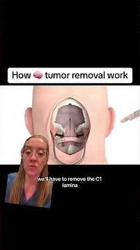 How surgery is performed on the brainstem and cerebellum. #neurosurgery #brainsurgery #craniotomy