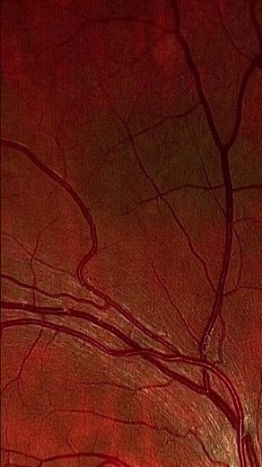Choroidal Nevus!