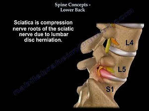 Sciatica And Lumbar Disc Herniation, causes and treatment