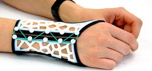 3D Printed splints help arthritis #3dthursday