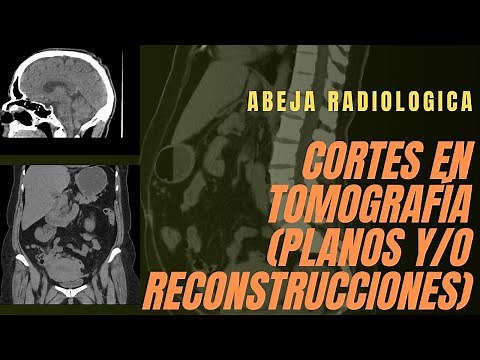 ✂️🧍🏻‍♂️ Cortes en tomografía (planos y/o reconstrucciones) ✂️🧍🏻‍♂️