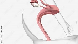 Stage 3 cervical cancer means the cancer has spread from where it started in the cervix into the surrounding tissue.