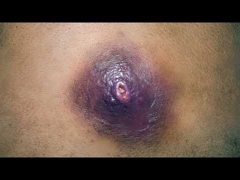 Boil Abscess Drainage Tutorial