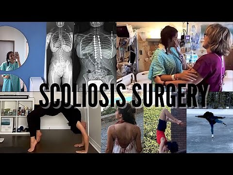 Scoliosis Surgery (3 years post-op)