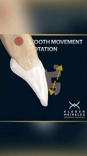 TYPES OF TOOTH MOVEMENT ROTATION - ORTHODONTIC TIPS #Shorts
