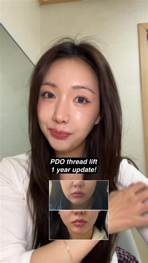 Anna Lee 지윤 on Instagram: "my 1 year update on my PDO thread lift since many people were asking!"