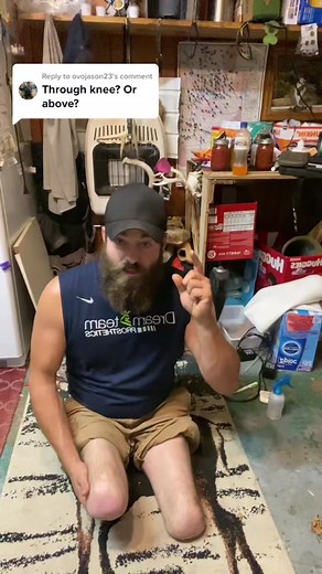 Understanding Different Levels of Limb Loss in Amputees