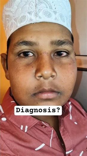 “Itchy Red Eyes" Every Summer? Comment Your Diagnosis? #eyes #viralshorts #optometry