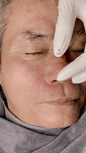 Episode 36| PART 2 Deep Black dot above eye popping 👁 #puntosnegros #pimple #pimplepop #pimplepopper