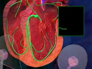 Electrocardiogram - What Is an ECG - Performing an EKG Video.flv