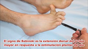 7.8K views · 126 reactions | El signo de Babinski (o signo de Koch)...