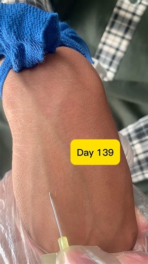 Smooth 24 Gauge IV Cannulation Technique | Forearm Vein (Day 139)#viralshorts #viralshort #safi