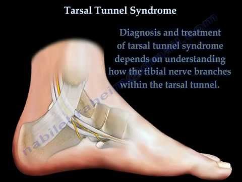 Tarsal Tunnel Syndrome - Everything You Need To Know - Dr. Nabil Ebraheim