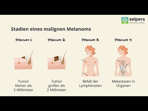Muss schwarzer Hautkrebs (malignes Melanom) behandelt werden? (Ärztin informiert)