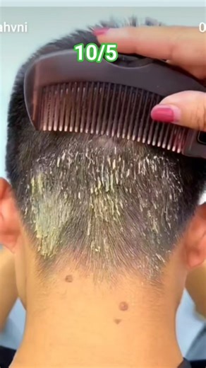 Try This Dandruff com 😱 10/5 How To The used dandruff removal