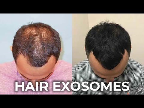 Thick & Healthy Hair with Exosomes Therapy: Before and After results