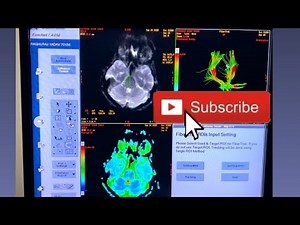 DTI post processing GE dti post processing game#mri #cardiacimaging #khowledge #live #medical