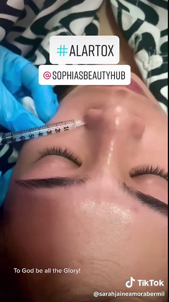 #alartox for nasal flaring🥰♥️
