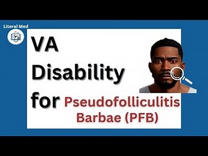 PFB (Pseudofolliculitis Barbae, Razor Bumps) VA disability | #pfb #veterans #vadisability #nexus