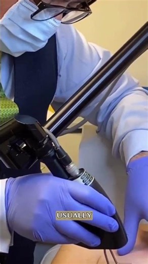 CO2 Laser for Decolletage