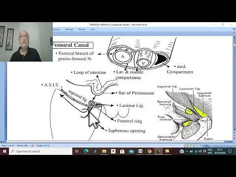 Hernia in Arabic 16 ( Femoral hernia , part 1 ) , by Dr. Wahdan