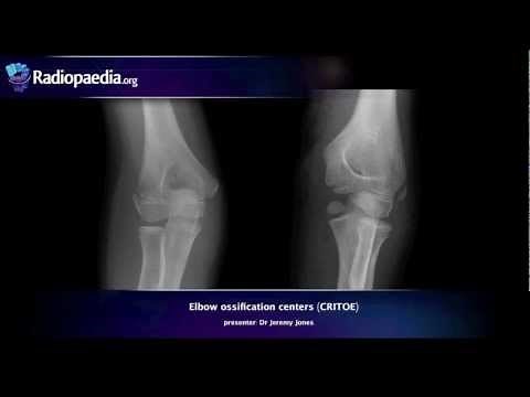 Elbow Ossification Centers (CRITOE) - radiology video tutorial • Video • MEDtube.net