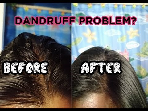 How to treat dandruff/dry scalp problem