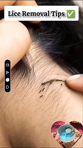 438K views · 967 reactions | ✅Lice Removal Tips At Home/Best Oil For Lice Removal . . . #liceremoval #nits #haircare #haircaretips #fbreelsfypシ゚ #reelsvideo #reelsviral #fbreels #reelschallenge #exploremore | Natural Beauty Remedy | Facebook