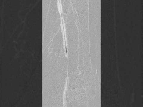 6F rotarex for a distal intrastent and native SFA trhombosis