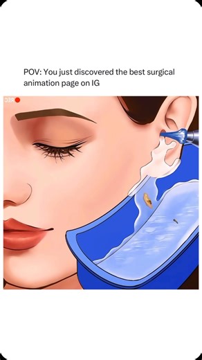Animations on Instagram: "Follow @surgicalanimation for more! 🏥"
