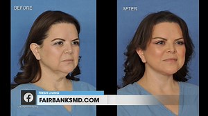 What you need to know before booking a facelift procedure