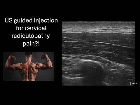 A novel procedure to treat cervical radiculopathy pain in the ED?
