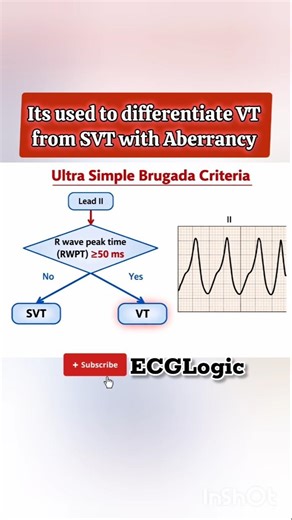 Ultra Simple Brugada Criteria for VT vs SVT #ecg #ekg #vt #svt #ecginterpretation