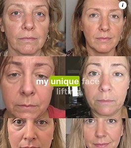 HOW TO LIFT YOUR FACE AND LOOK 5-10 YEARS YOUNGER IN A SHORT TIME? I SHOW IN MY LIFTING PROGRAM 🔥 Join now 👉🏻 https://faceplasty.online/lifting-19?utm_source=smm&utm_medium=fb&utm_campaign=lifting-19&utm_content=reels&utm_term=english | Dr. Ales Ulishchenko