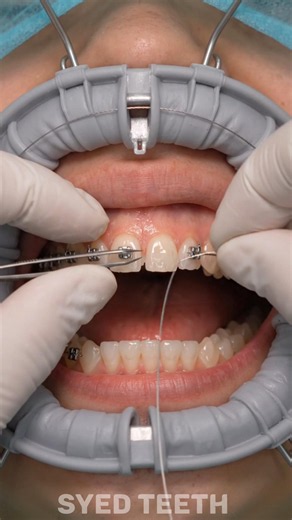 Open Front Teeth Gap Closure 🦷 Orthodontic Alignment | Perfect Result