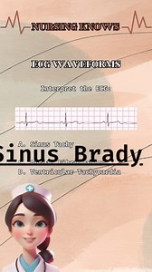Nursing quiz 🩺 📌 ECG WAVEFORMS | 💊 Comment down your answers and score! 🌟 You can support us by sending stars! 📍 Check out some other nursing quizzes! Link: https://www.facebook.com/nursingknows/videos 📍 Subscribe to our FB page by clicking the link below: https://www.facebook.com/becomesupporter/nursingknows/ Don't forget to follow and like our page ❤ #fypシ゚viralシ #NursingKnows #fypシ゚s #nurses #nursing #nurselife #nursingschool #nursingstudent #medical #medicalschool #medicalstudent #vira