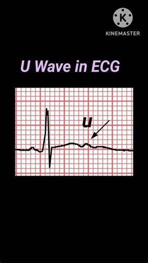 U Wave in ECG, U Wave Explained Understanding U Wave