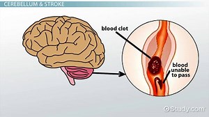 Cerebellar Stroke: Symptoms & Treatment