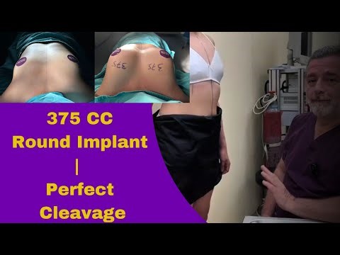 Breast Augmentation Surgery: Our 25-Year-Old Patient’s 375 CC Journey