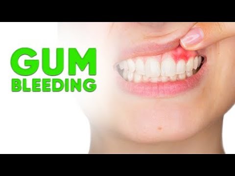 How to Stop Gum Bleeding: Effective Treatments and Tips