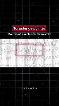 [OSCE: ECG Diagnosis] Which Rhythm is shown in this ECG and what is the treatment?