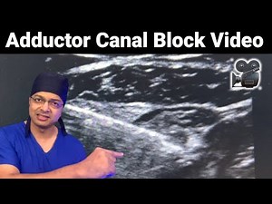 ADDUCTOR CANAL BLOCK Ultrasound Video | Saphenous nerve & Nerve to Vastus Medialis ( NVM) Block |