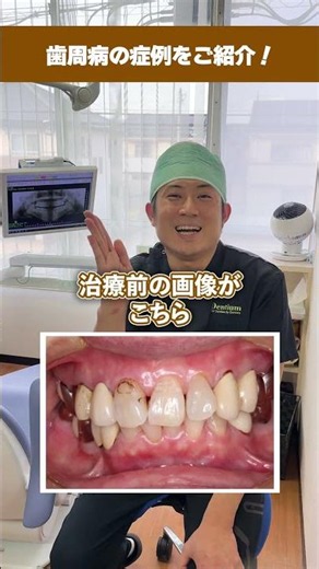 【歯周病のリアル】歯茎から血が出る・腫れやすい悩みを一発解決！歯医者さんが実際の改善症例をビフォーアフターで解説！#shorts